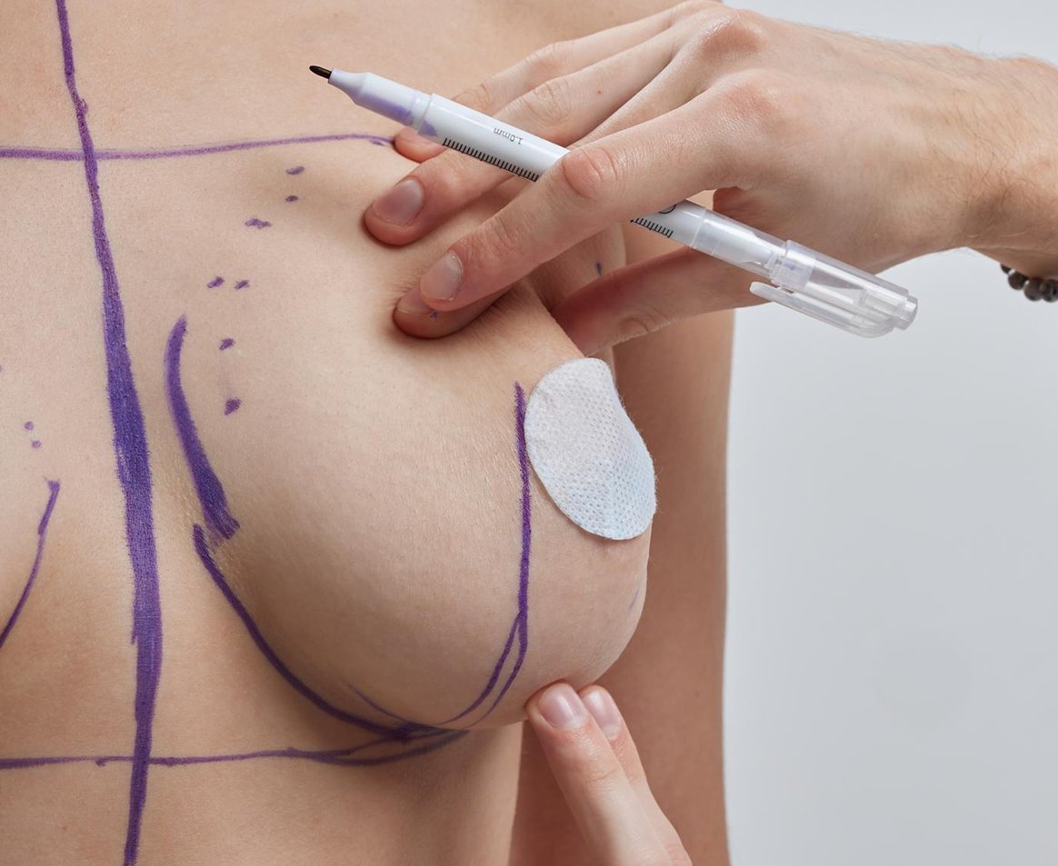 MAMOPLASTIA REDUTORA